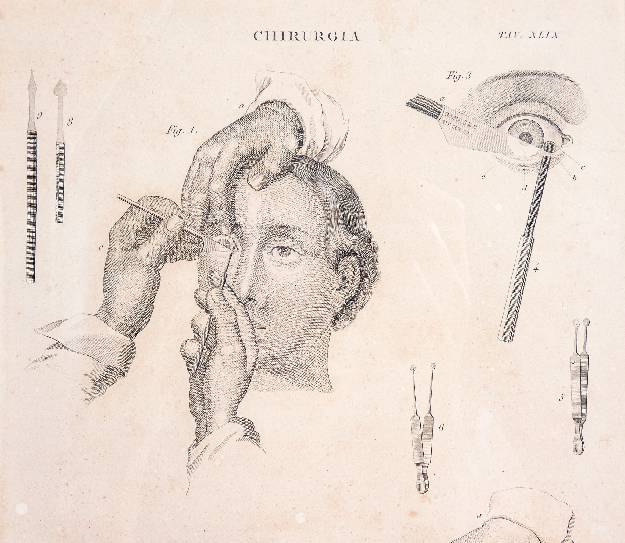 grafica 1800 pastore incisione medicina chirurgia oculistica oftalmica ottica 1