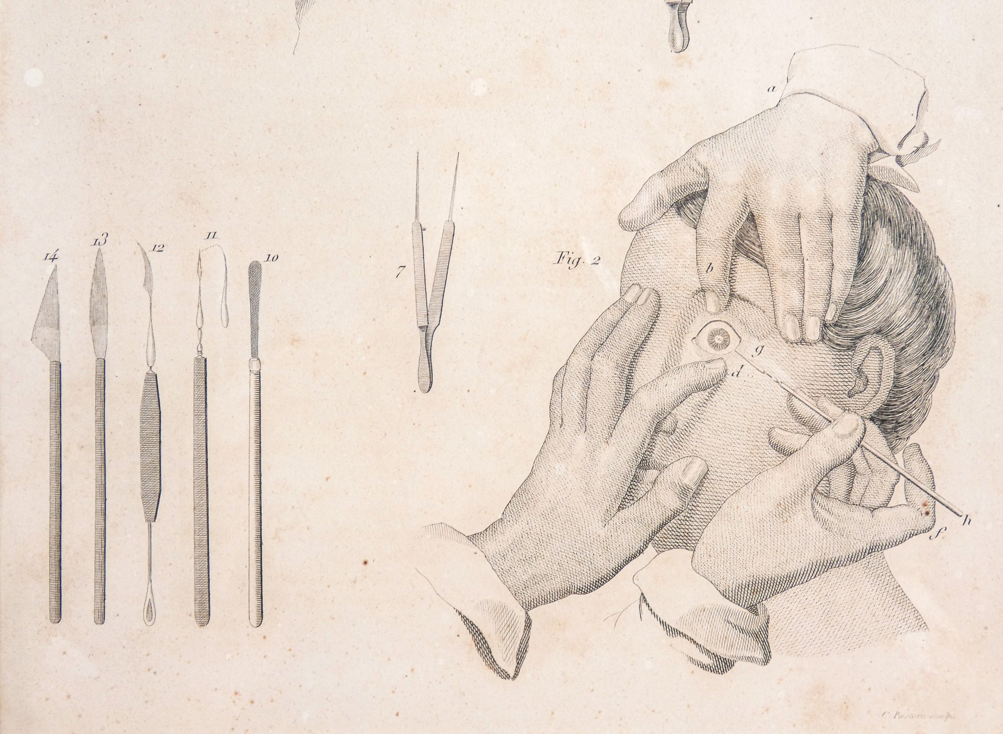 grafica 1800 pastore incisione medicina chirurgia oculistica oftalmica ottica 1