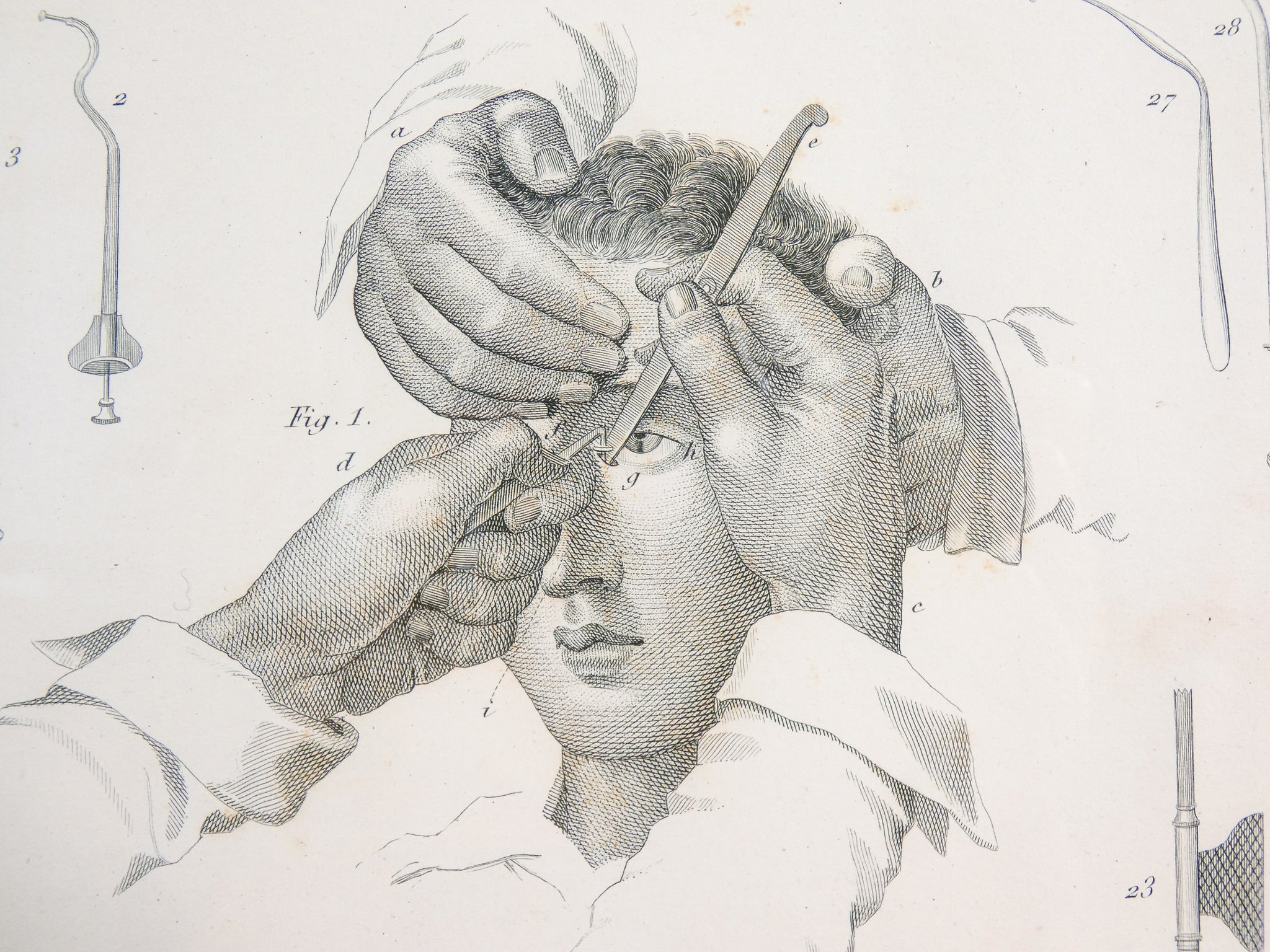 grafica 1800 pastore incisione medicina chirurgia oculistica oftalmica ottica 2