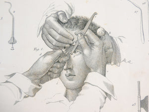 grafica 1800 pastore incisione medicina chirurgia oculistica oftalmica ottica 2