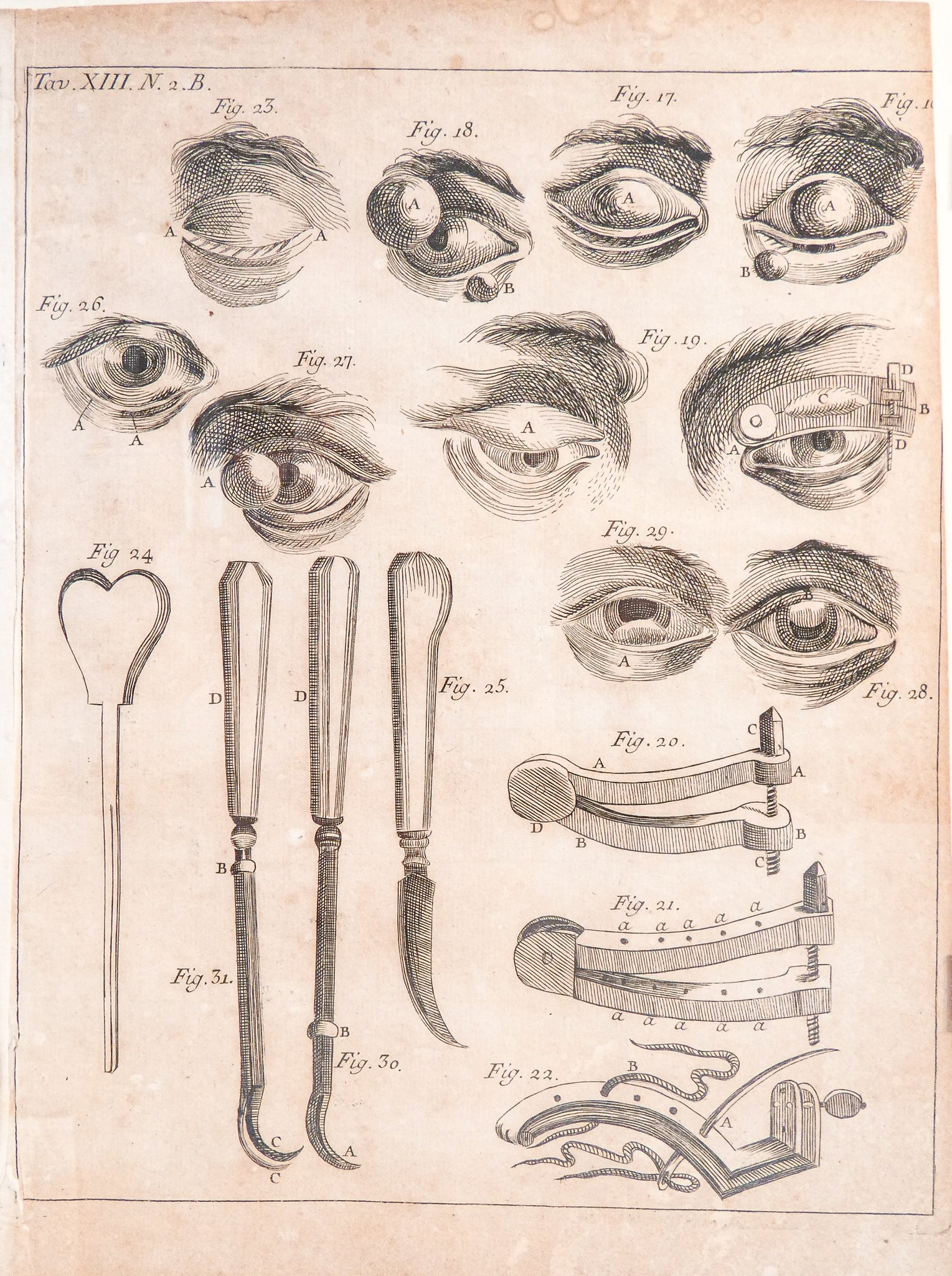 stampa grafica 1715 incisione medicina chirurgia oculistica oftalmica ottica